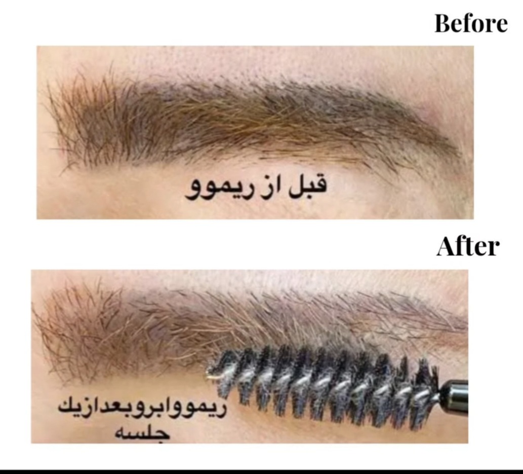 «پاک کردن تاتو با متد روز و مواد حرفه‌ای» 